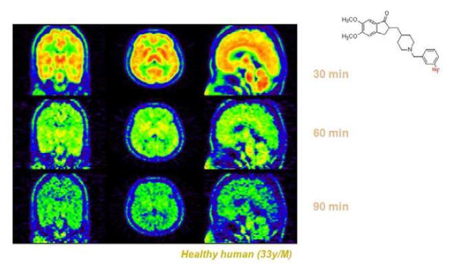 정상인에서 3-[18F]F-Donepezil의 PET-CT 영상