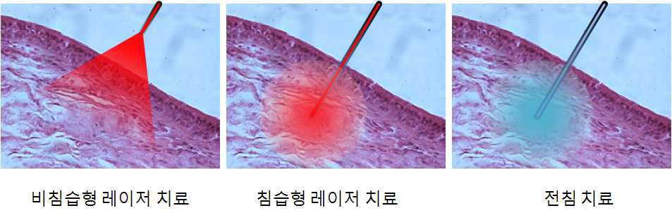 비침습형 레이저 치료, 침습형 레이저 치료, 전침 치료의 모식도