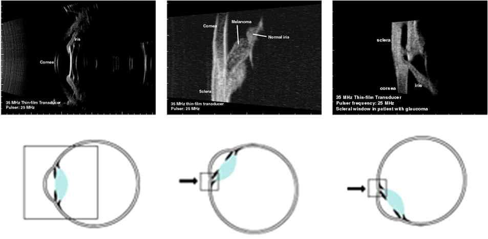 A typical ultrasonic images obtained with the CLI ultrasonic imaging device
