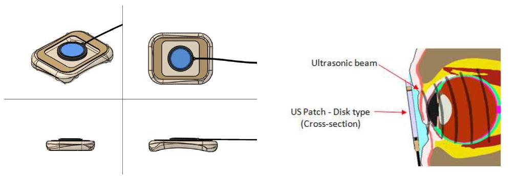 초음파 가이드로 UCC 상단면에 부착된 UEP