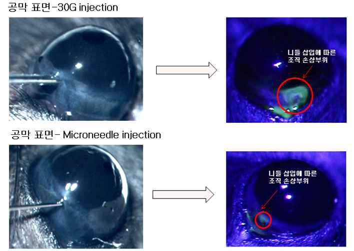 30G 니들과 유리체강 주사용 약물전달기기(Microneedle)의 삽입부위 조직손상 비교
