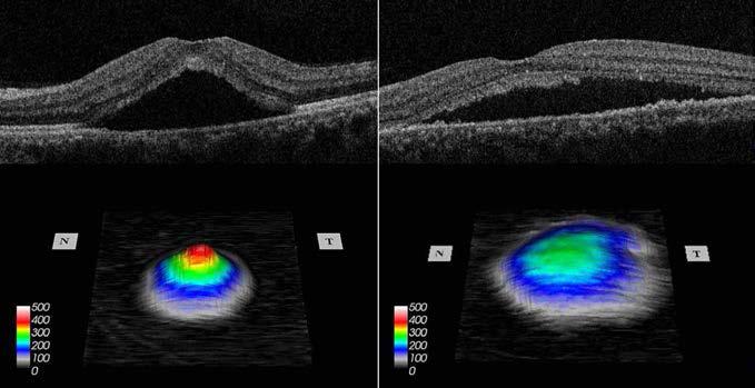중심 장액성 맥락망막병증의 경우 급성기(좌측)와 만성기(우측)에 얻어지는 OCT 영상