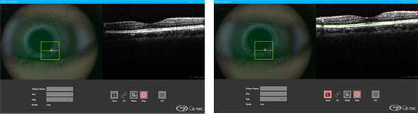 시제품으로 개발한 Retina OCT FOI로 획득 망막 영상(좌)과 segmenatation이 실행된 영상(우)