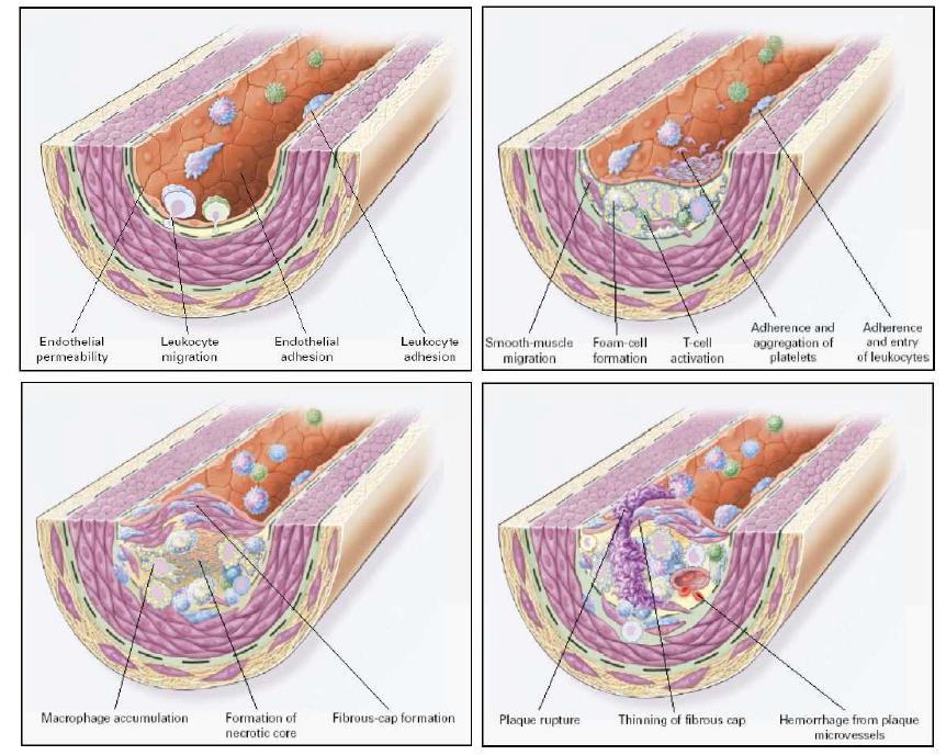혈관에서 동맥경화의 진행 단계