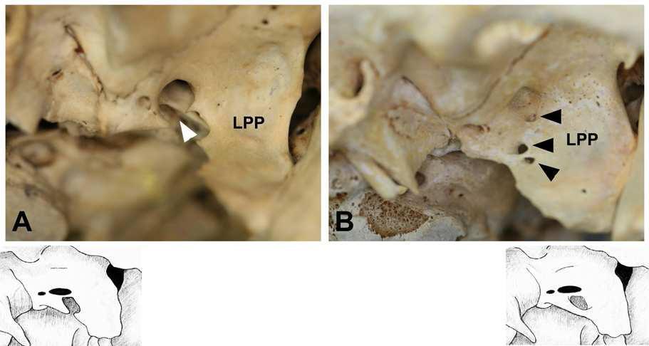 Ossified pterygospinous ligament. (A) incomplete pterygospinous bridge (white arrow head) and (B) complete pterygospinous bridges (black arrow heads). LPP; the lateral plate of the pterygoid process