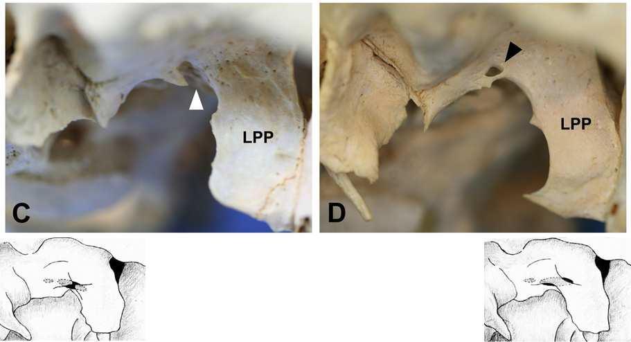 Ossified pterygoalar ligament. (C) incomplete pterygoalar bridge (white arrow head) and (D) complete pterygoalar bridge (black arrow head).