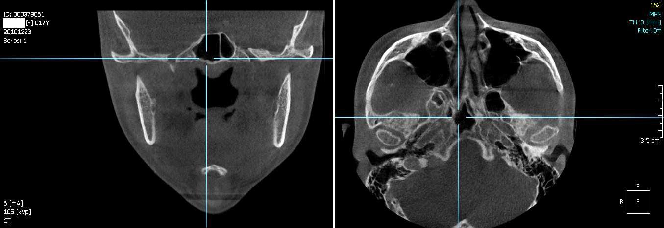 CT촬영을 통한 머리뼈 계측