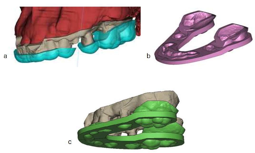 머리뼈 3차원 영상(a)과 구강내 3차원 영상(b)을 정합시켜 환자의 머리뼈 구조와 구강 구조가 일체화된 환자 맞춤식 머리부위 3차원 모델(c)을 최종적으로 형성시키는 영상 병합단계