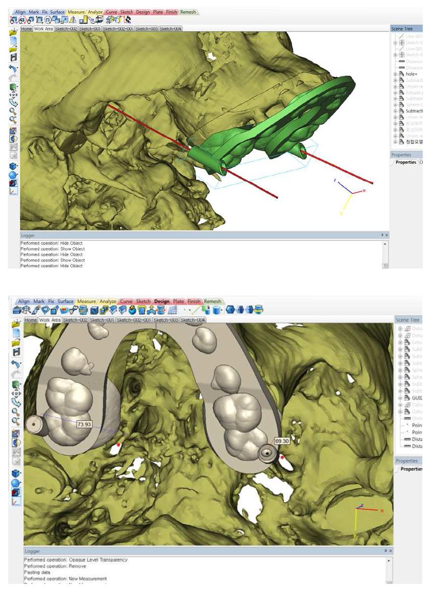 영상 병합을 통하여 얻어진 환자 맞춤식 머리부위 3차원 모델로부터 환자의 삼차신경절 위치지점을 검출하고, 검출된 삼차신경절 위치지점과 환자 위턱 둘째큰어금니 가쪽을 잇는 직선이 하측으로 연장될 시 환자의 치아에 물린 유도장치 본체를 통과하게 되는 라인을 따라 바늘유도관을 유도장치 본체에 형성