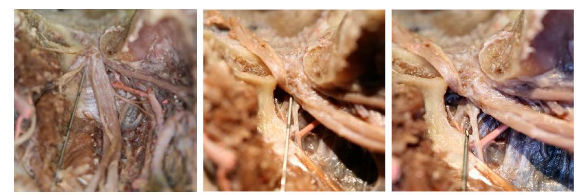 시신을 해부한 결과, 바늘은 가쪽날개근을 통과하여 아래턱신경줄기의 안쪽을 지나 타원구멍을 통과하였으며, 진행과정 중 다른 신경혈관다발을 손상시키지 않았음.