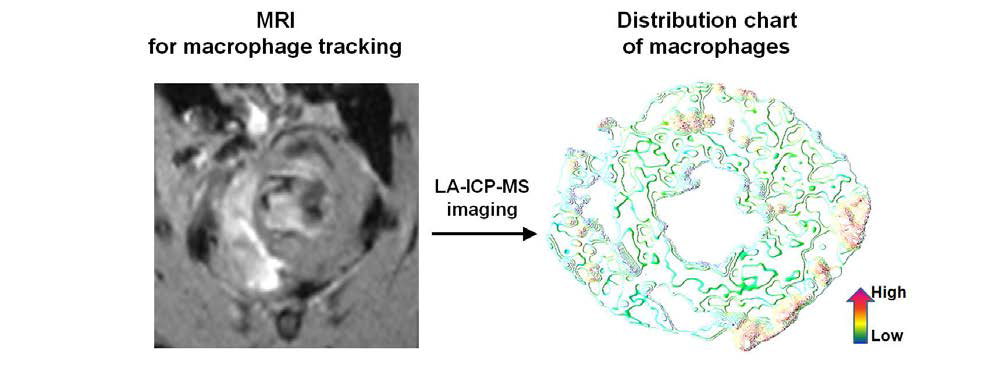 MRI를 통해 얻은 심근염 영상과 LA-ICP-MS 영상을 통해 구현된 대식구 분포도