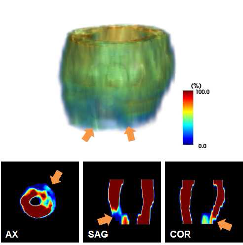 2차원 심근염 MNP-MRI 영상을 재구성한 3차원 영상.