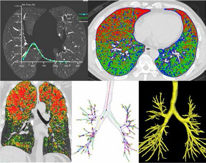 만성기도폐쇄성질환(COPD)에서 CT를 이용한 영상연구(폐실질, 대기도, 소기도 분 류)
