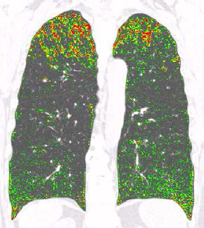 CT density기반 폐실질 분석 기법