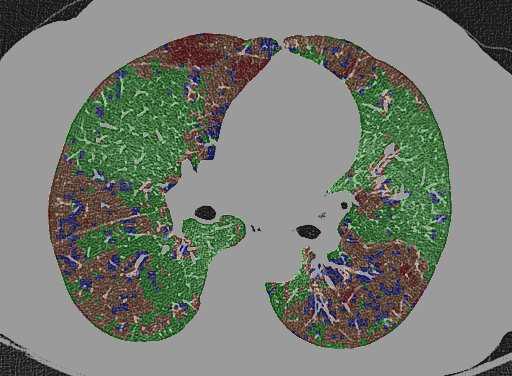 개발된 자동분류법에 의한 폐영역 분류 (빨강-중증폐기종, 주황-경증폐기 종, 녹색-정상, 파랑-Bronchiolitis Obliterans)