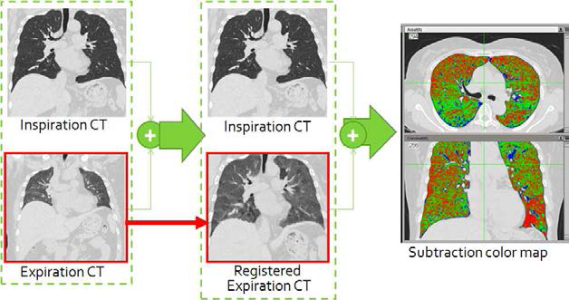 흡기와 호기 상태의 두 폐영상을 자동 정합하는 소프트웨어