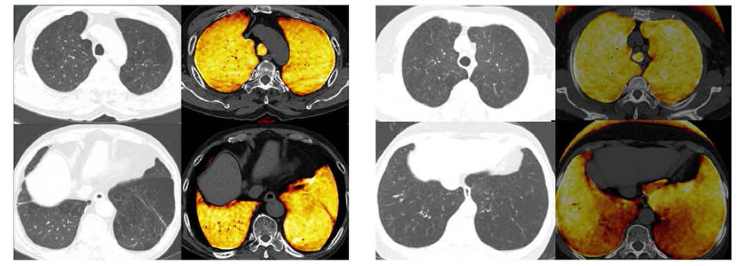 COPD 환자의 제논환기 CT. 두 환자 모두 유사한 중증 폐기종을 가지고 있으나 좌측 그림의 환자에서는 정상소견을 보이고 우측그림의 환자에서는 광범위한 환기 결손부가 나타남