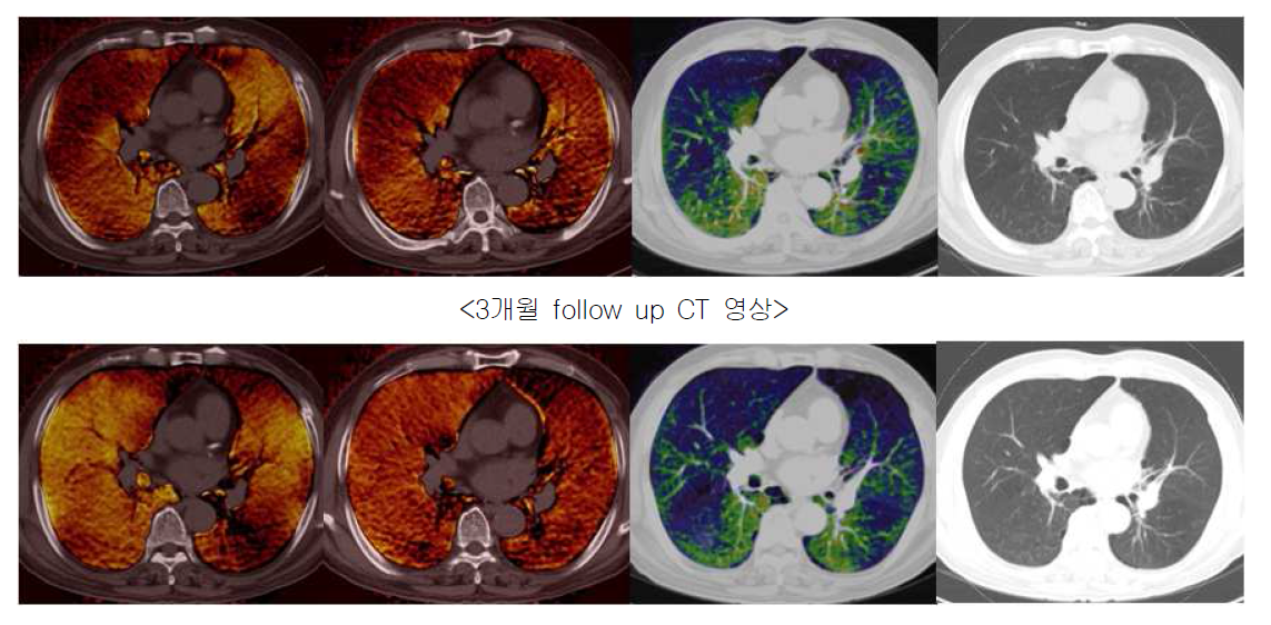 같은 환자의 initial, 3개월 follow up CT 영상 (Wash-In, Wash-Out, Perfusion, CT 영상 순)으 로 3개월 follow up의 Wash-In과 Wash-Out 영상에서 오른쪽 폐의 폐환기의 개선을 볼 수 있으나 Perfusion 영상에서 오른쪽 폐의 폐관류는 의미있는 변화는 볼 수 없다.