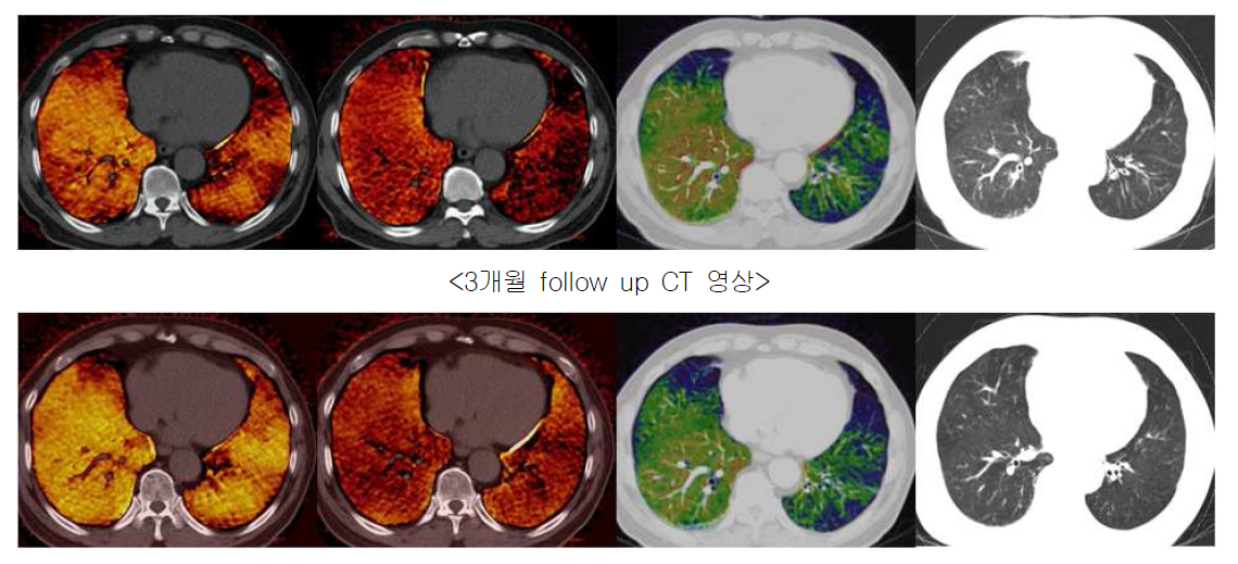 같은 환자의 initial, 3개월 follow up CT 영상 (Wash-In, Wash-Out, Perfusion, CT 영상 순)으 로 3개월 follow up의 Wash-In과 Wash-Out 영상에서 양측 폐의 폐환기의 개선을 볼 수 있으나 Perfusion 영상에서 양측 폐의 폐관류는 의미있는 변화는 볼 수 없다.