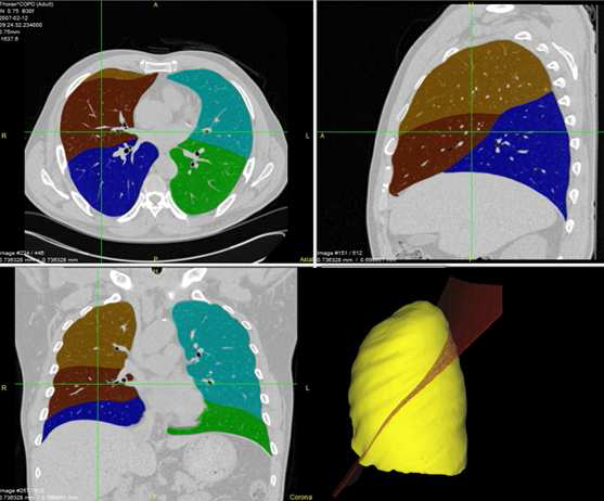 Hessian Matrix기반의 Fissure detection을 이용하여 surface fitting기반의 엽 분할.