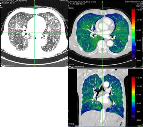 a) 해부학적 CT 폐 영상, b) DECT를 이용한 Xenon 흡입 조영증강 Axial 폐 관류 파라매트릭 시각화 영상, c) DECT를 이용한 Xenon 흡입 조영증강 Coronal 폐 관류 파라매트릭 시각화 영상