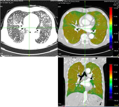 a) 해부학적 CT 폐 영상, b) DECT를 이용한 Iodine 조영증강 Axial 폐 혈류 파라매 트릭 시각화 영상, c) DECT를 이용한 Iodine 조영증강 Coronal 폐 혈류 파라매트릭 시각화 영상