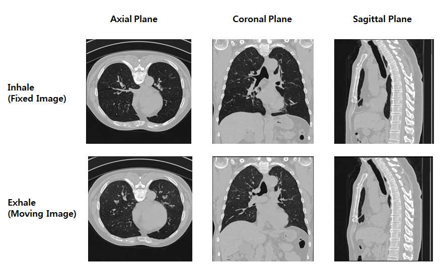 폐 흡기 호기 Axial, Coronal, Sagittal Views