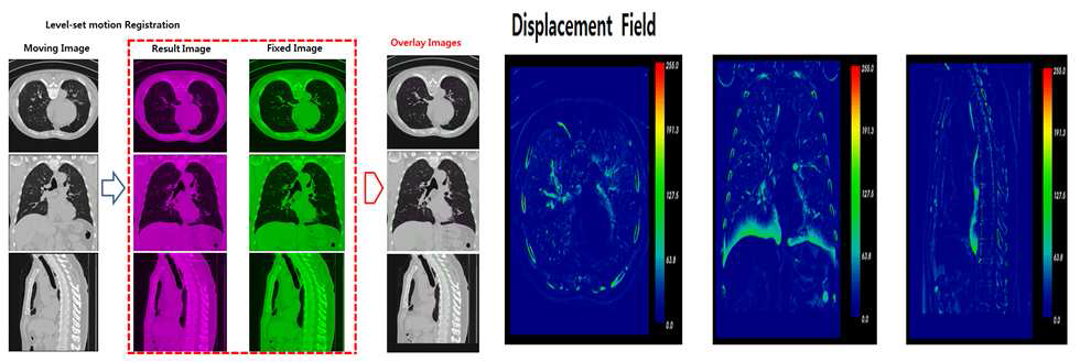 Level Set 기반 폐 흡기 호기 Lung Registration 결과 및 Deformable Map