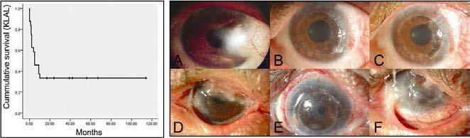 본원에서 각막윤부이식술을 시행 받은 24안의Kaplan-Meier 생존곡선 (좌), 각막윤부 이식술 이후 임상양상 (우)