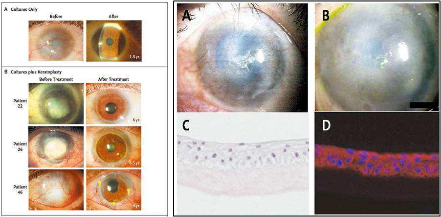 자가윤부줄기세포이식술을 시행 전후 안구표면의 변화 (좌), 화학화상에 의한 윤부결핍 환자에서 윤부줄기세포이식술 후 임상양상 과 조직 사진 (우)