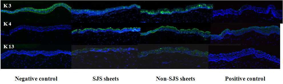 스티븐스 존슨 증후군 환자 (SJS)의 구강점막상피세포 시트 이식 후 cytokeratin (K3,K4,K13) 발현 비교