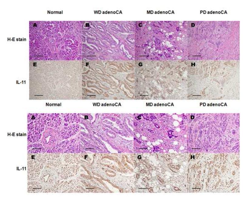 췌장암조직에서의 IL-11 발현