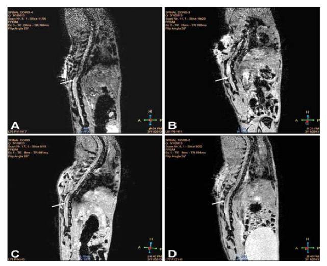 MRI 영상이미지를 이용한 루게릭 질환 모델에 이식한 나노입자 표지된 인간지방줄기세포 (신경분화 세포) 호밍 추적 분석.