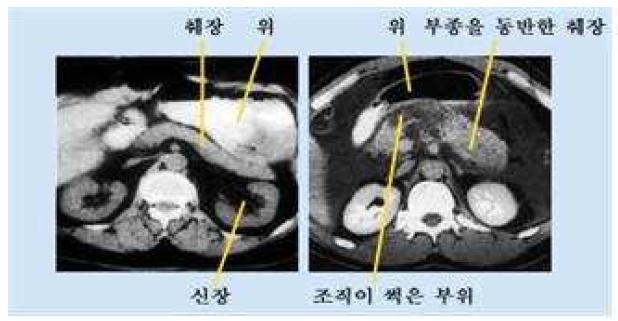 [보고서]성체 줄기세포에 의한 급성췌장염 치료 최적화를 위한 주요 표적 인자 발굴
