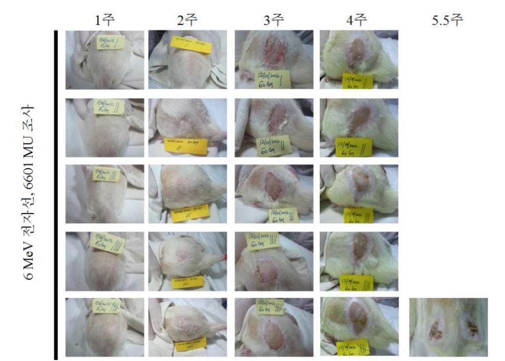 양측 둔부의 6 MeV 전자선 6601 MU 조사 후 5주까지 관찰