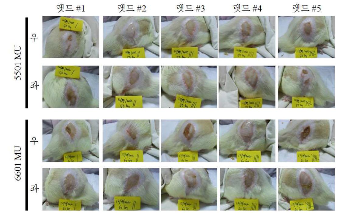 양측 둔부의 전자선 조사 4주 후 피부 변화