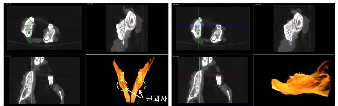 방사선 조사가 이루어진 하악골의 골괴사 부위의 micro CT 확인