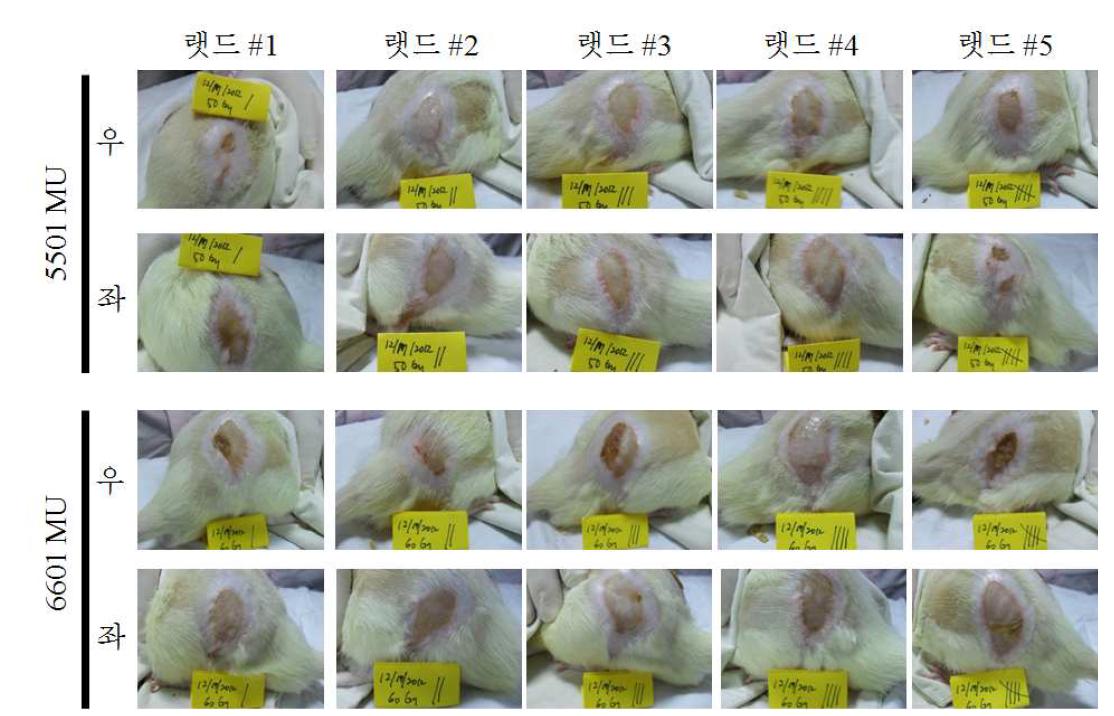 양측 둔부의 전자선 조사 4주 후 피부 변화