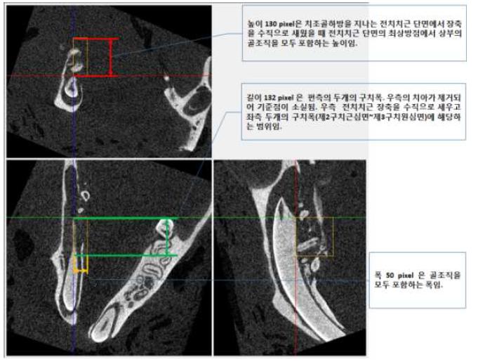 관심영역의 설정