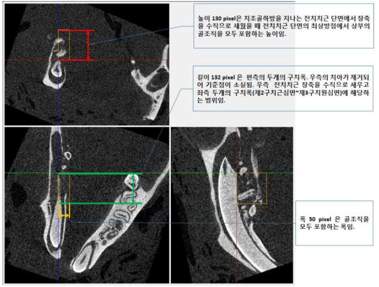 관심영역의 설정