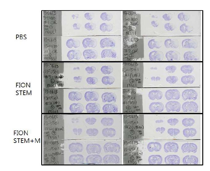 니슬 염색을 통한 뇌경색 정도 비교. 중간엽 줄기세포만 넣었을 때 보다 자석으로 유도시켰을 경우 더 효과적으로 뇌경색의 크기가 줄어듦. 위; 대조군 중간; 중간엽 줄기세포 아래; 중간엽 줄기세포를 자석으로 병변부위에 유도시킴.