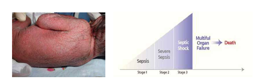 패혈증(Sepsis)에 감염된 신생아 및 패혈증의 진행 과정