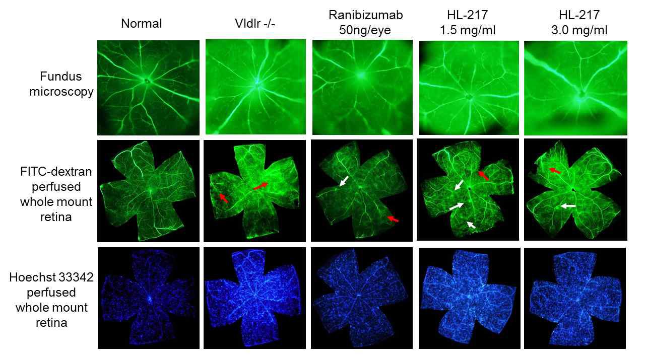 Two-weeks treatment of HL-217 inhibited pathogenic subretinal eovessels and retinal vascular leakage in Vldlr-/- mouse.