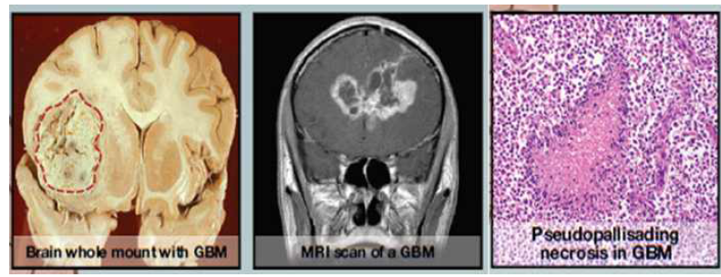 악성신경교종환자의 뇌병변 모습, MRI 사진, 염색 사진을 통해 악성신경교종세포가 높은 세포분열 속도와 다양한 세포가 섞인 다형성적인 특성과 정상 조직으로 넓게 퍼져나가는 세포 침윤의 특성, 악성신경교종 환자의 암조직에서 특이적으로 발견되는 세포 괴사(necrosis) 모습을 보여 주고 있음