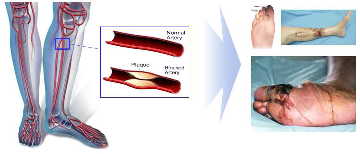 중증 하지 허혈 및 족부 궤양