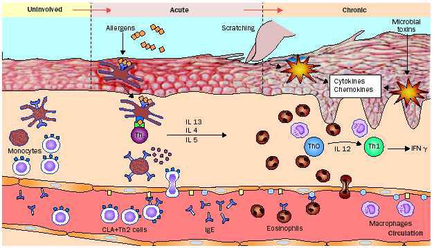 Immunological pathways in atopic dermatitis