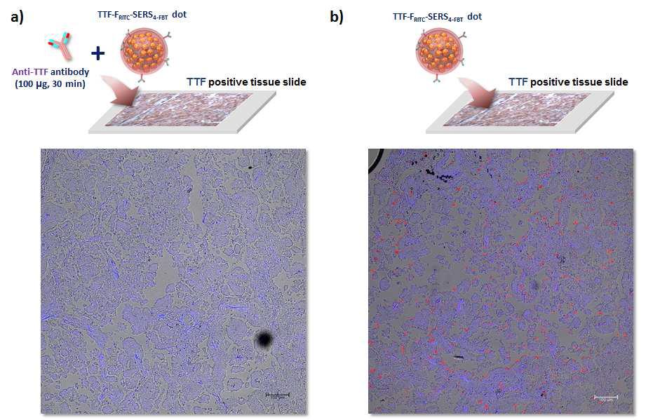TTF-1 항체가 결합된 형광-라만 표지 나노입자를 처리한 생검 조직의 공초점레이 저주사 현미경 (CLSM) 이미지. (a) TTF-1 항체의 전처리 후 TTF- 항체가 결합된 형광-라만 표지 나노입자를 처리한 조직의 영상, (b) TTF-1 항체가 결합된 형광-라만 나노입자만 처리한 생검 조직의 영상.