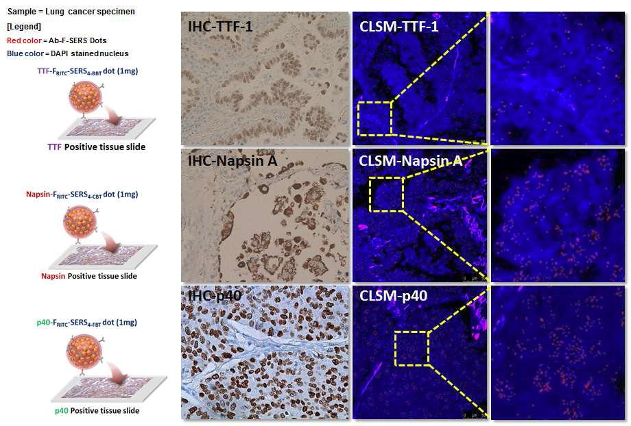 생검조직에 발현된 바이오마커 (TTF-1, Napsin-A, p40)에 대한 면역 조직화학염색법 (Immunohistochemisty, IHC) 결과와 항체가 결합된 형광-라만 표지 나노입자를 처리한 생검 조직의 공초점레이저주사현미경 이미지