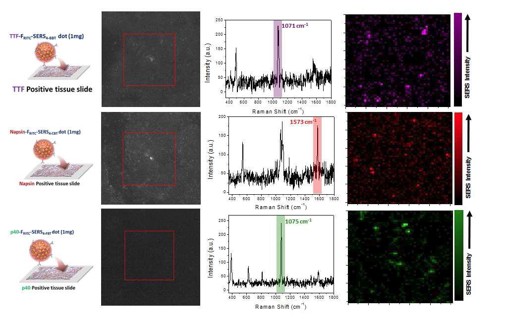 TTF-1, Napsin-A, 또는 p40 항체가 결합된 형광-라만 표지 나노입자를 처리한 생검 조직 시료의 라만 조직 영상