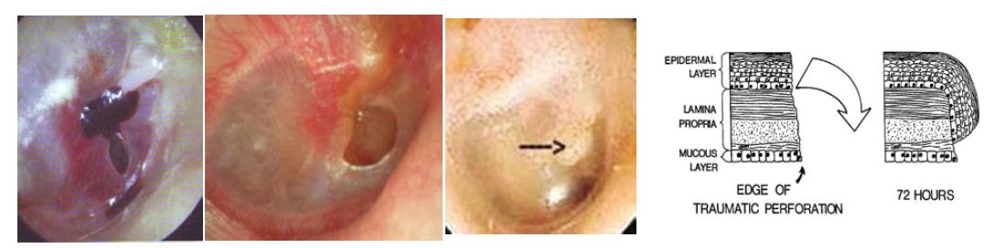 손상된 고막의 복구 과정